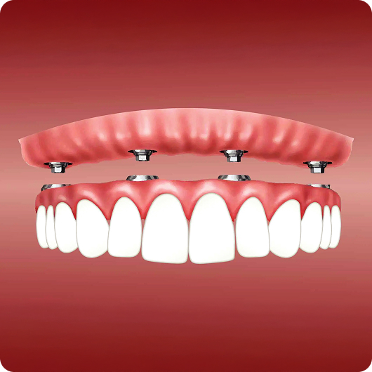 Implant Right