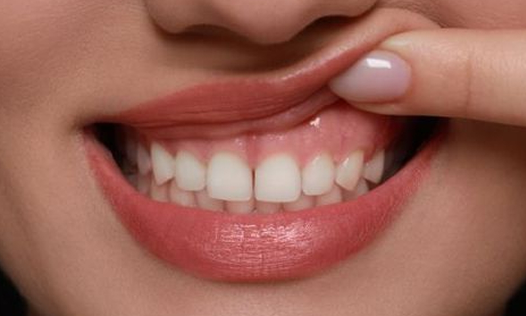 Creating a Smile