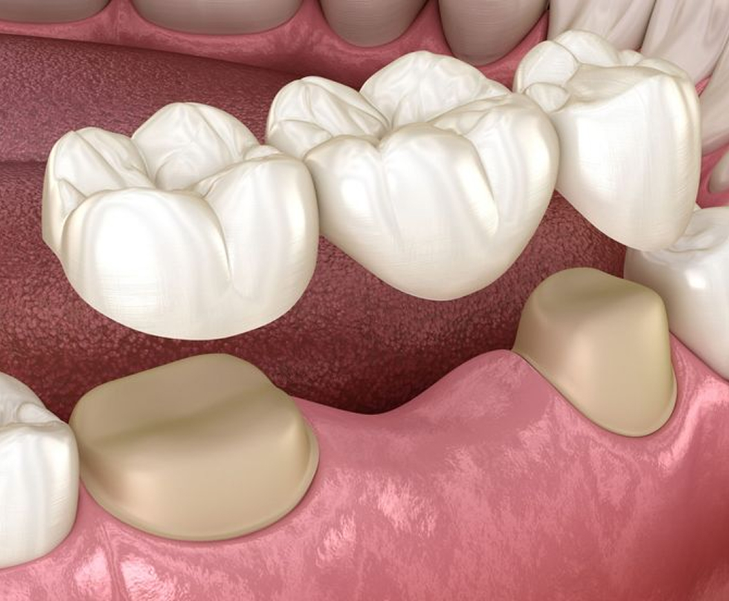 Dental Bridges