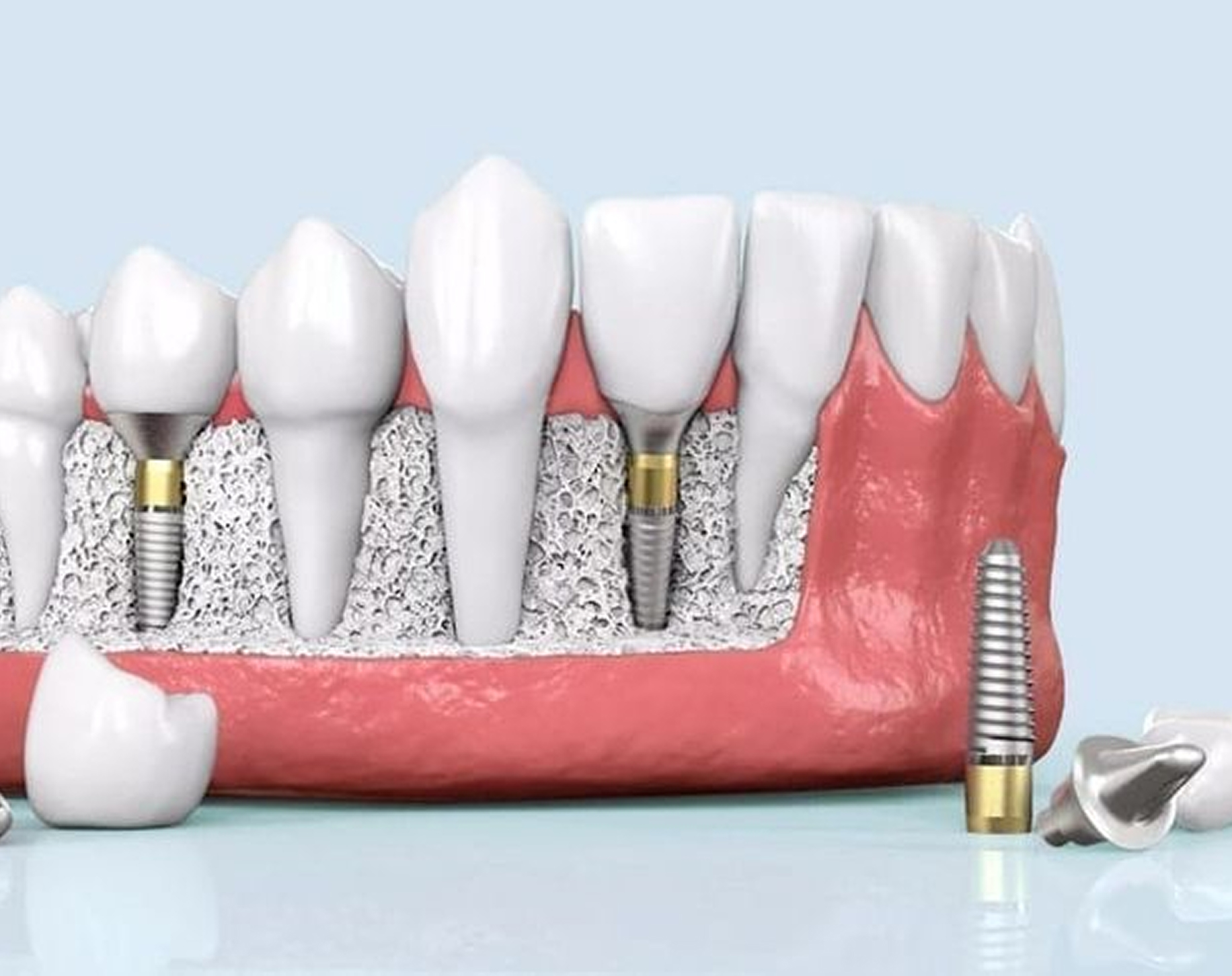 Dental Implants