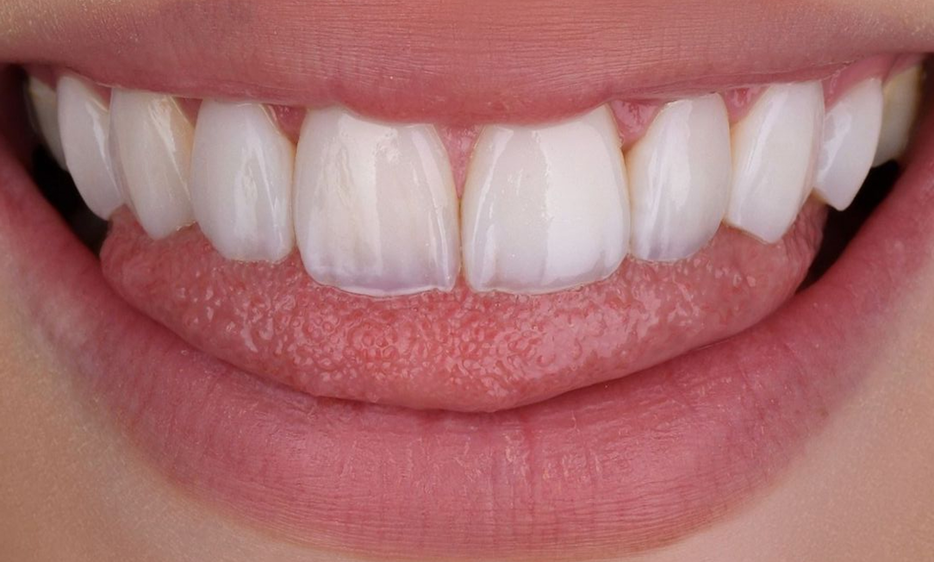 Zirconia Crowns