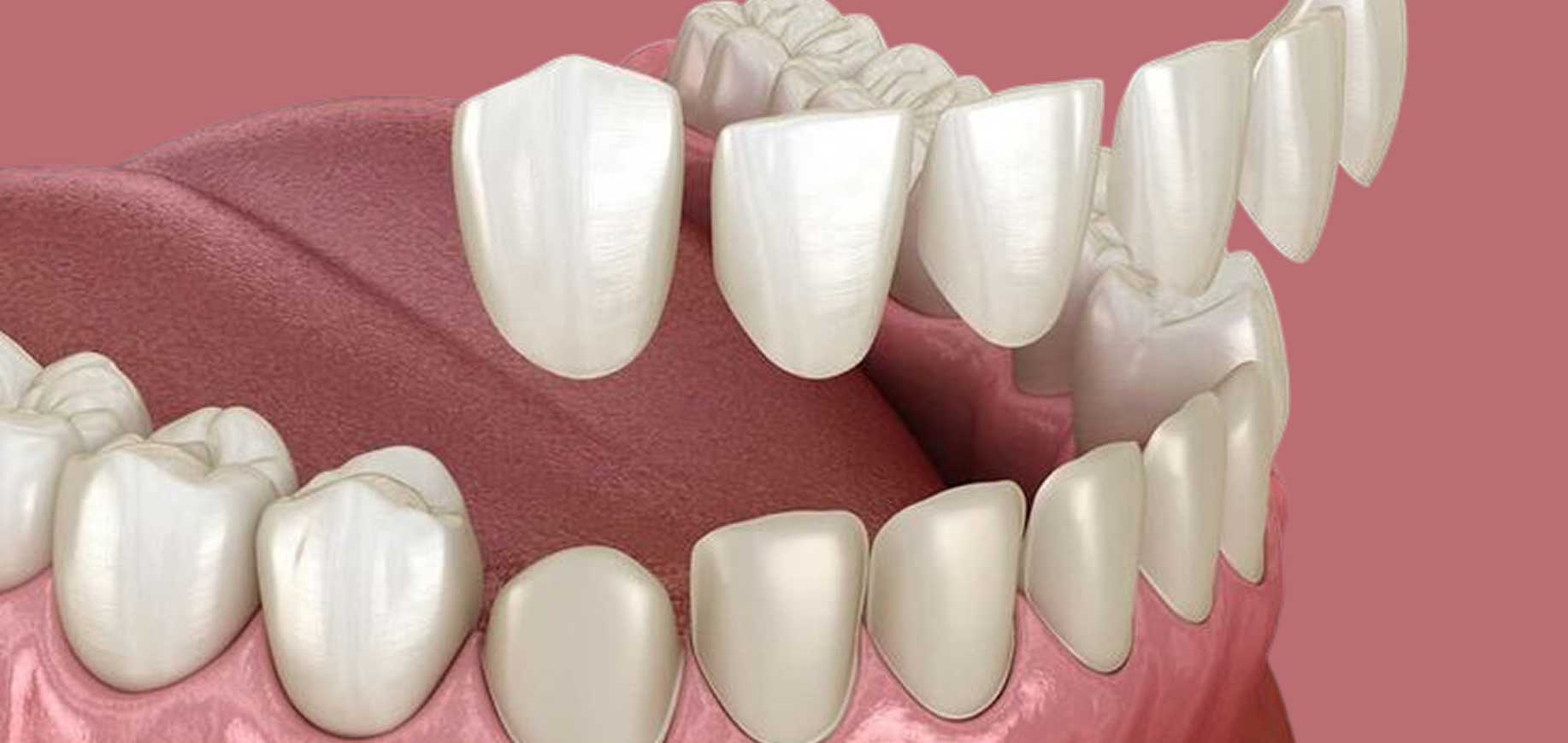 E-Max Veneers