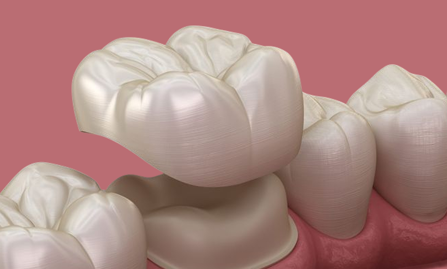 Porcelain Crowns