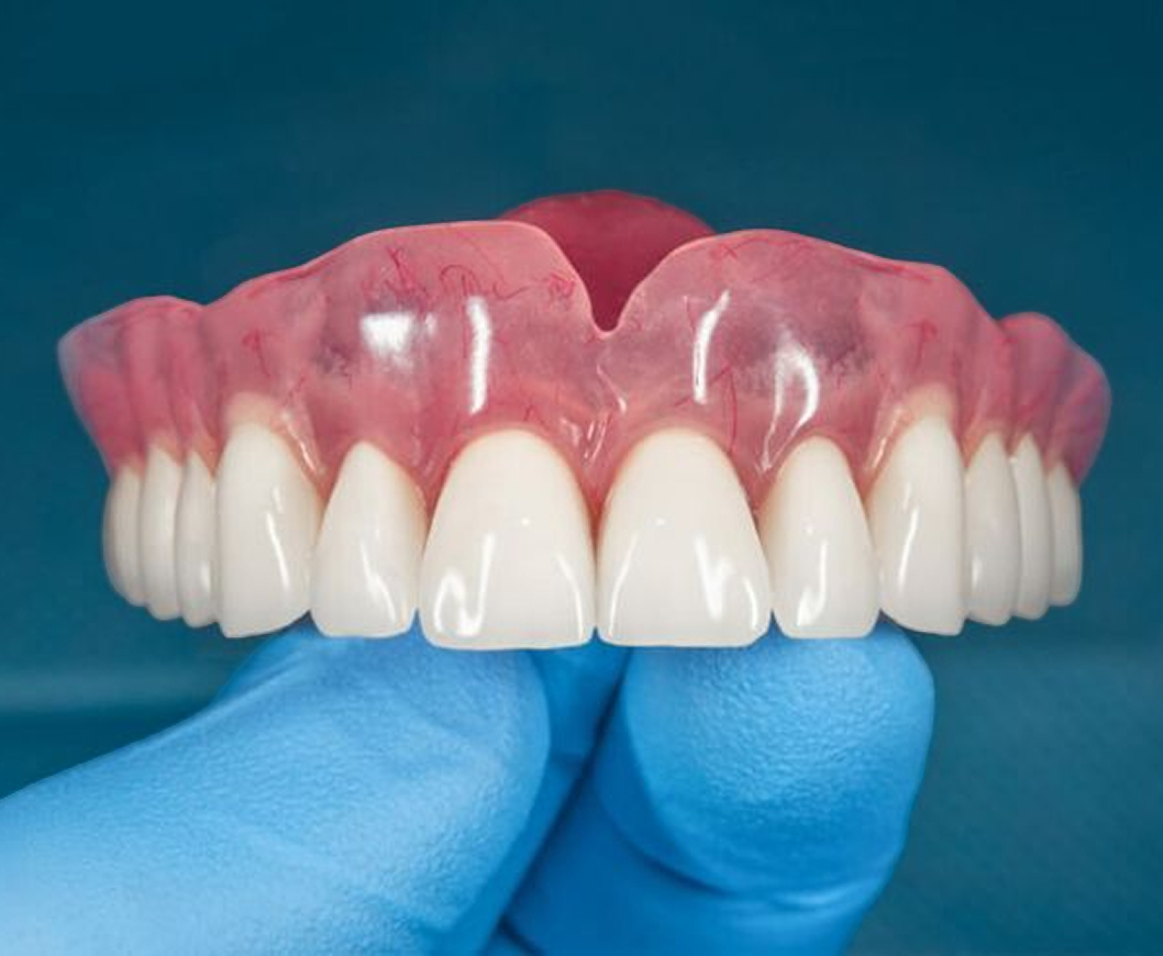 Dental Bridges Variant