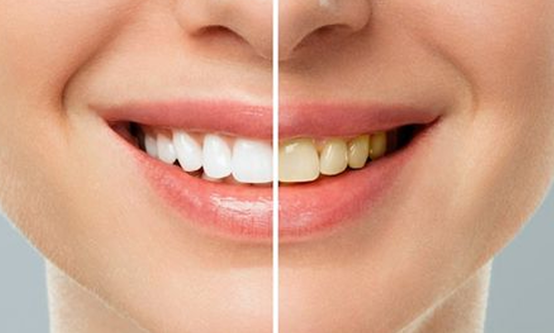 Creating a Smile