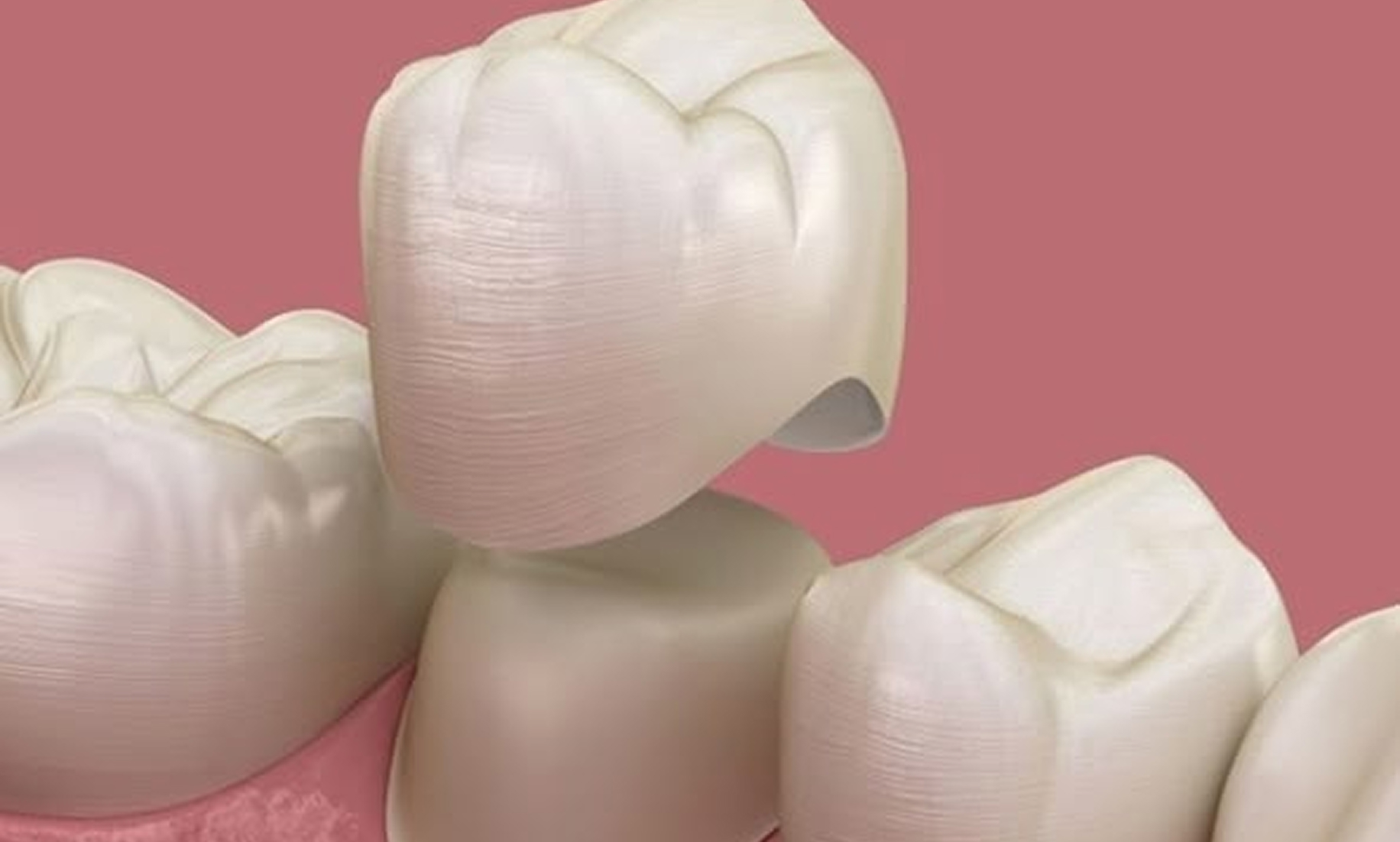 Metal-Ceramic Crowns